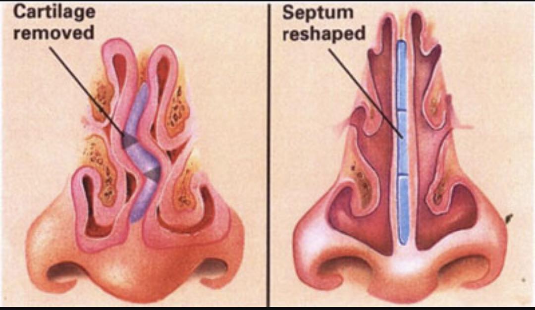 nose surgery cyprus limassol nicosia.jpg